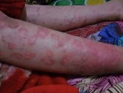 Usai Vaksinasi, Seorang Warga Limapuluh Kota Diduga Alami Ruam pada Kulit